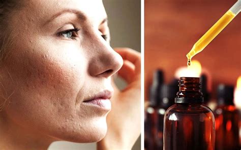 Essential Oils for Acne: What You Need to Know | The Healthy