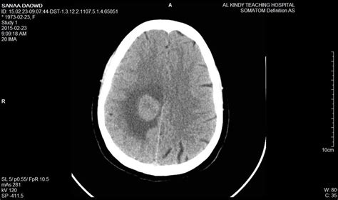 CT-scan image of brain tumor. | Download Scientific Diagram