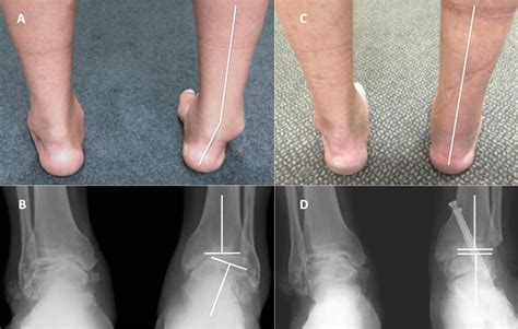 Ankle Arthritis (Swollen Ankle Joint) | The London Foot & Ankle Clinic