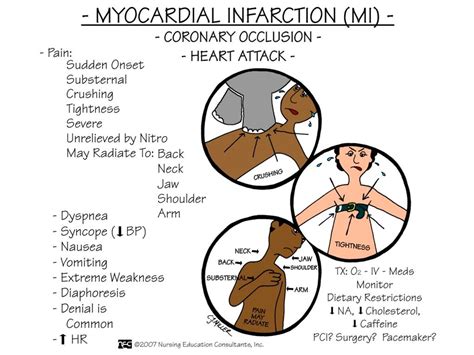 Myocardial Infarction (MI)-ABC Medicine