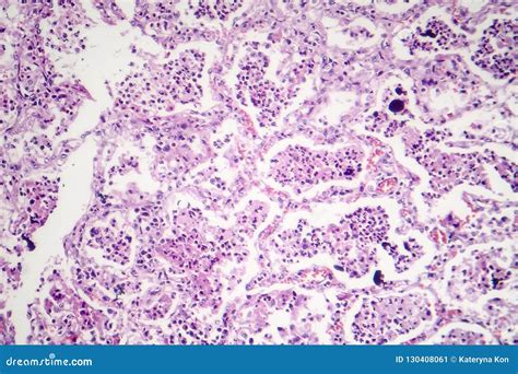 Lobar Pneumonia Histology