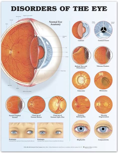 Disorders of the Eye {Infographic} - Best Infographics