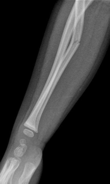 Greenstick Fracture Radiology