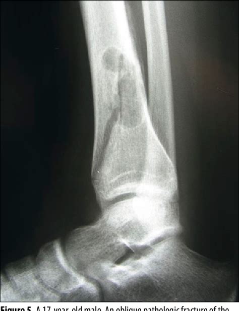 Figure 4 from Cortical fibrous defects and non-ossifying fibromas in ...