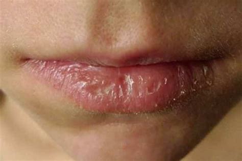 Dry Patches on Lip, Upper, Lower, Pictures, Causes, Not Cold Sore ...