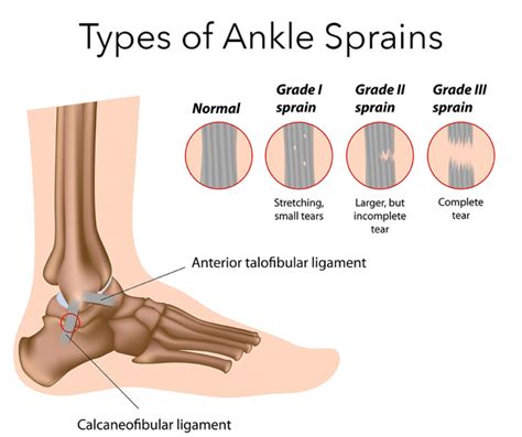 Ankle Sprain | Symptoms, Treatment, & Recovery Time