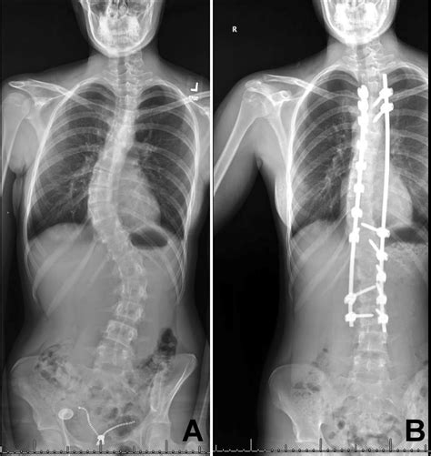 Cureus | Acute Appendicitis After Spine Fusion for Adolescent ...