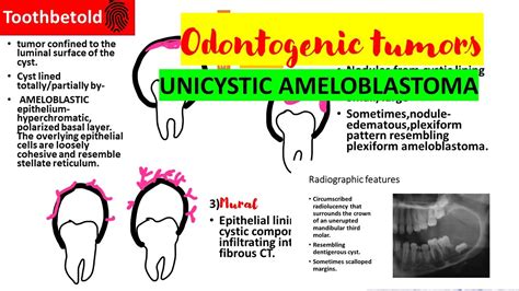 Unicystic ameloblastoma | Odontogenic tumors Oral pathology ...