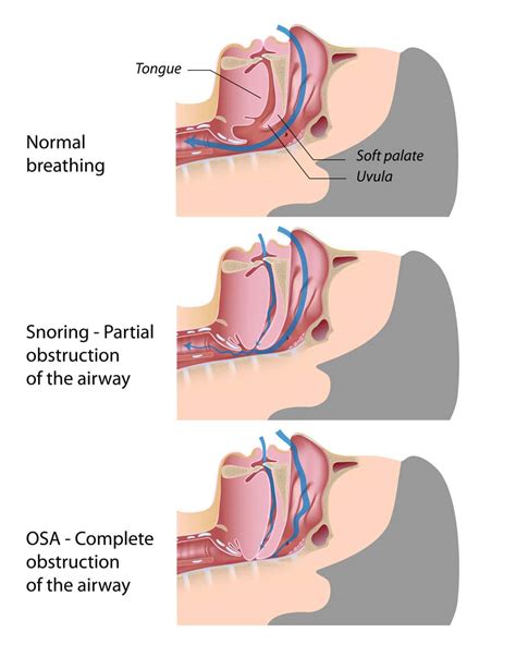 Sleep Apnea Surgeon: Diagnosis & Effective Treatment