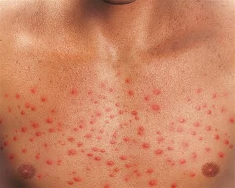 Cirrhosis Rash: Is Your Rash Caused By Hepatitis? - Fatty Liver Disease