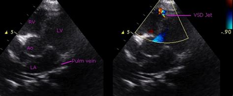 Small muscular ventricular septal defect – echocardiogram – All About ...