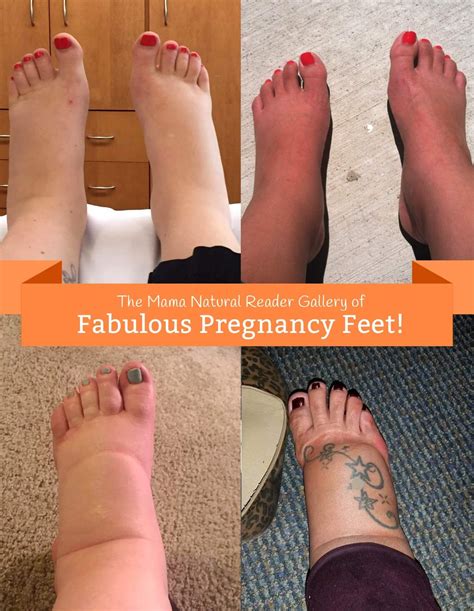 Swollen Feet During Pregnancy (Edema) Natural Remedies | Swollen feet ...