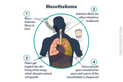 Signs And Symptoms Malignant Mesothelioma 2022 2022E Jurnal