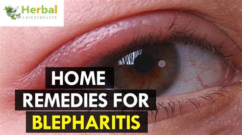 How to Cure Blepharitis Naturally with Home Remedies! - Natural Health News