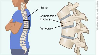 Vertebral Compression Fractures : Advanced Pain Management Center ...