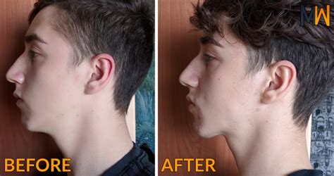 Mewing: The Orthodontic Technique That Can Improve Your Jawline ...