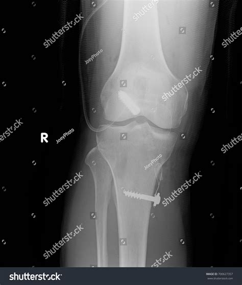 Film Operative Process Right Knee Ap Stock Photo 700627357 | Shutterstock