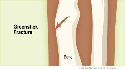 Greenstick Fracture