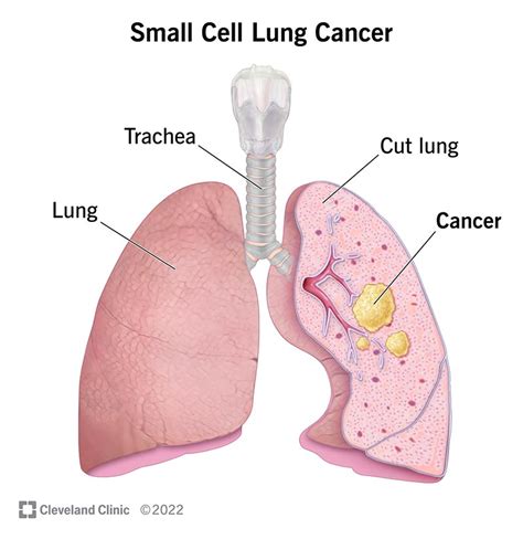 Small Cell Lung Cancer: Symptoms, Causes & Treatment