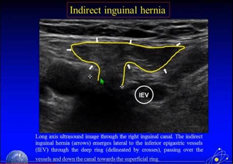 De 506 bästa hernias- groin-bilderna på Pinterest | Vårdskolor, Hälsa ...