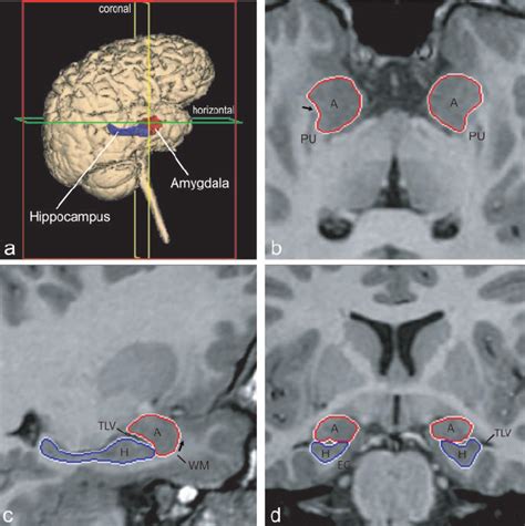 Orthogonal views for segmenting the amygdala and hippocampus on MRI ...