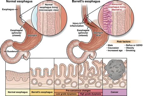 Barrett’s esophagus - AGA GI Patient Center