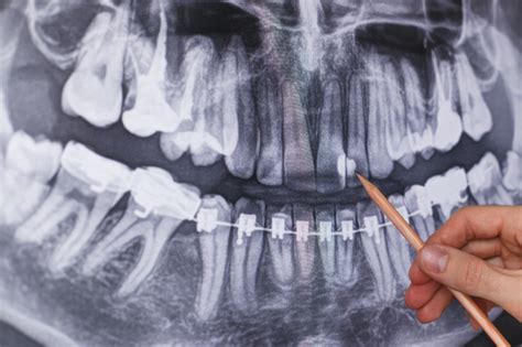 The Procedure, Types, and Need for Dental Bone Graft Surgery