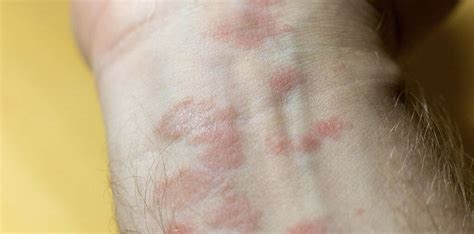 Scabies Rash: What Is a Scabies Rash?