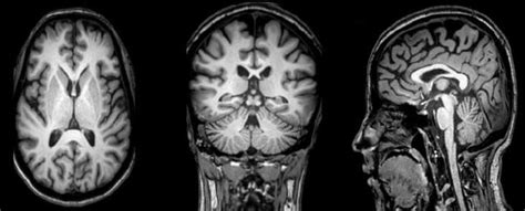 MRI planes for MRI head scan (a) Axial (b) Coronal (c) Sagittal MR ...