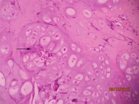 CHONDROSARCOMA – Histopathology.guru