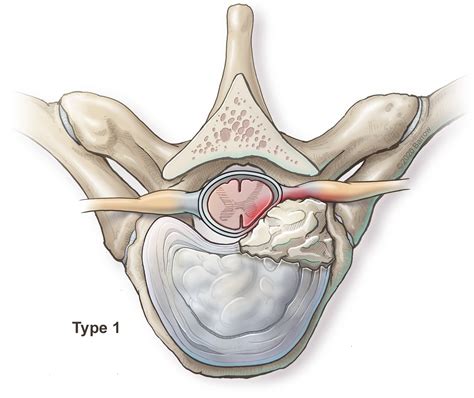 Herniated Disc Thoracic Mri