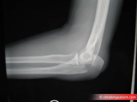 Elbow (Olecranon) Fracture | Rehab My Patient