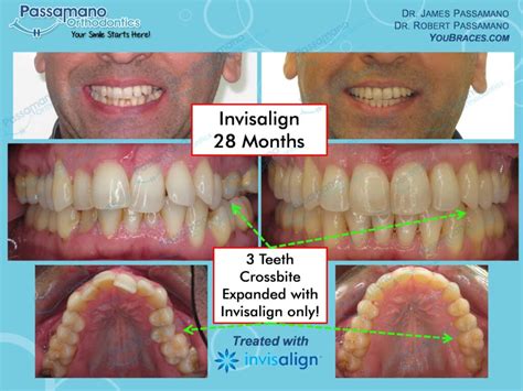 Invisalign Adult Crossbite and Great Result - Passamano Orthodontics