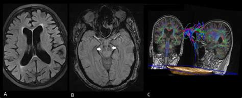 Figure 1 from Brain MRI in Parkinson's disease. | Semantic Scholar