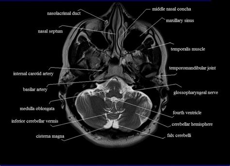 Mri Anatomy Of Brain - ANATOMY