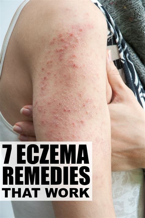 What causes eczema flare ups - indianlockq