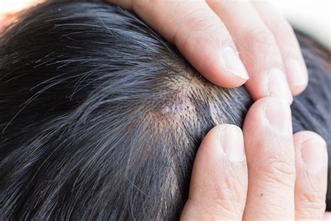 Scalp Psoriasis: Symptoms, Causes, Treatment & Tips - BeatPsoriasis.org