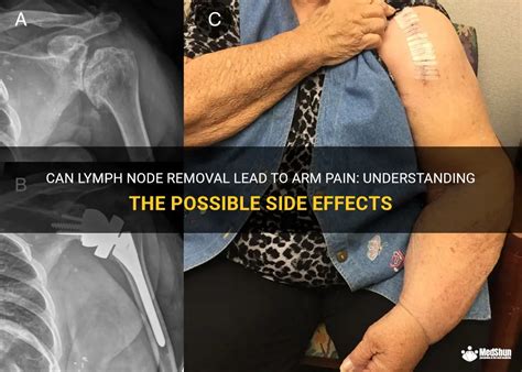 Can Lymph Node Removal Lead To Arm Pain: Understanding The Possible ...