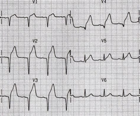 anterior STEMI q waves. Q waves are considered pathological if: > 40 ms ...