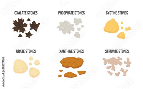 Kidneys stones types. Flat vector illustration: oxalate stones ...