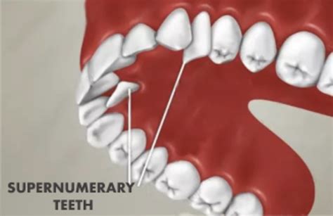 Supernumerary teeth - treatment