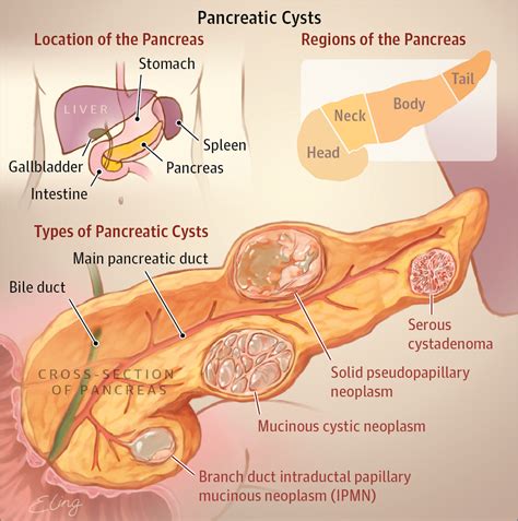 Types of Pancreatic Cysts | Gastroenterology | JAMA | JAMA Network