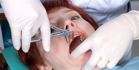 broken tooth extraction procedure Archives - Elite Dental Care