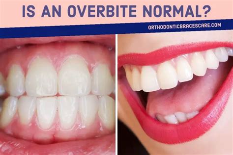 Is An Overbite Normal? How To Diagnose It? - Orthodontic Braces Care