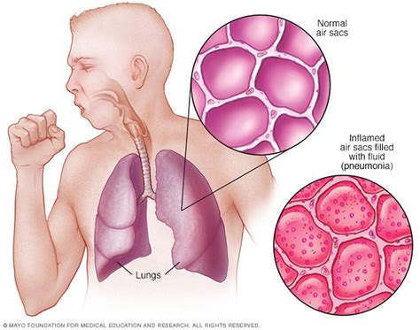 Neumonía - Síntomas y causas - Mayo Clinic