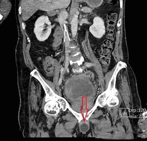 Suprapubic Catheter Replacement