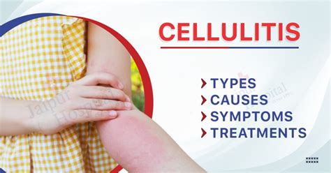 Cellulitis: Types, Causes, Symptoms, and Treatments