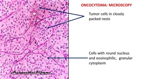 Pathology of Renal Oncocytoma - Pathology Made Simple