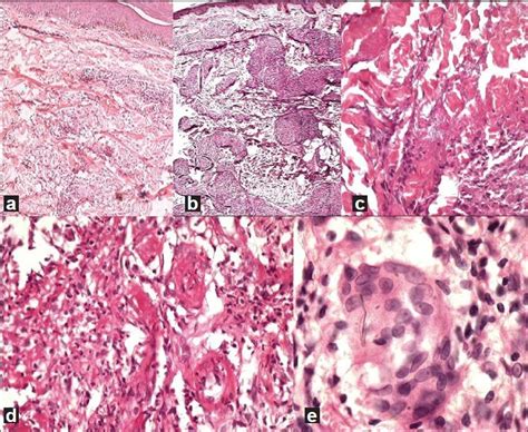 Granuloma annulare - Histology reconsidered - Indian Journal of ...