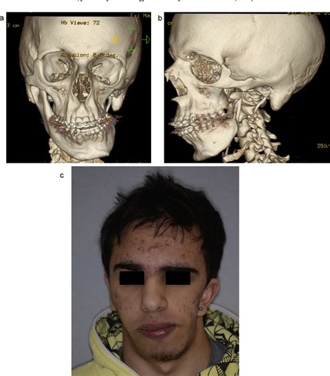 Figure 1 from Reconstruction of nongrowing hemifacial microsomia ...